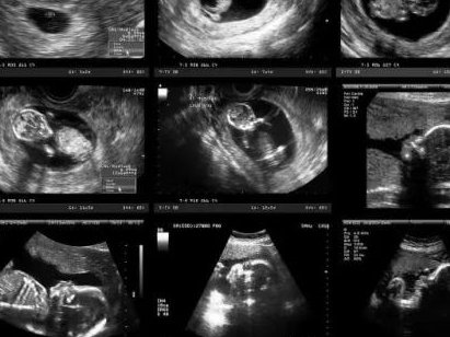 防城港三代试管能避免胎停吗？