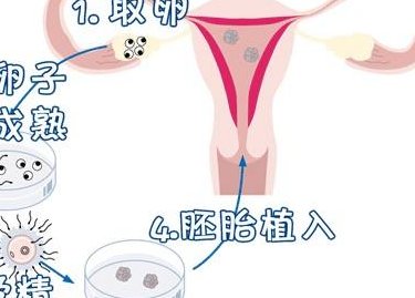 2026华西二院取卵费用不便宜！能否报销可提前了解下